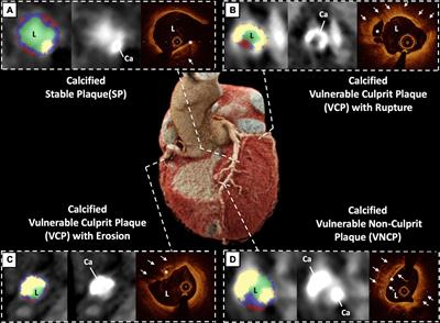 Frontiers Coronary Computed Tomography Angiography Analysis of